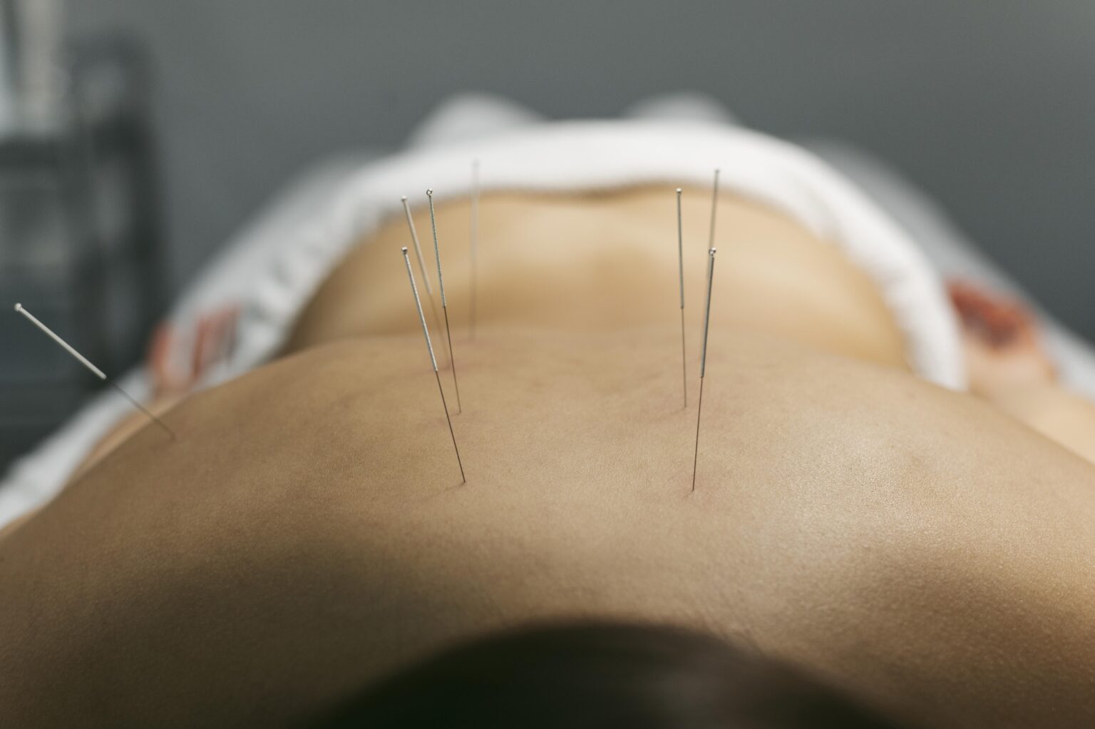 Dry Needling 